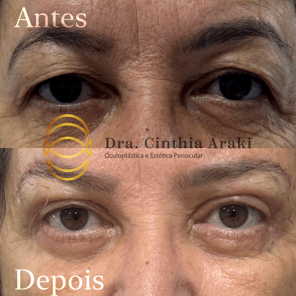 Antes e depois 1