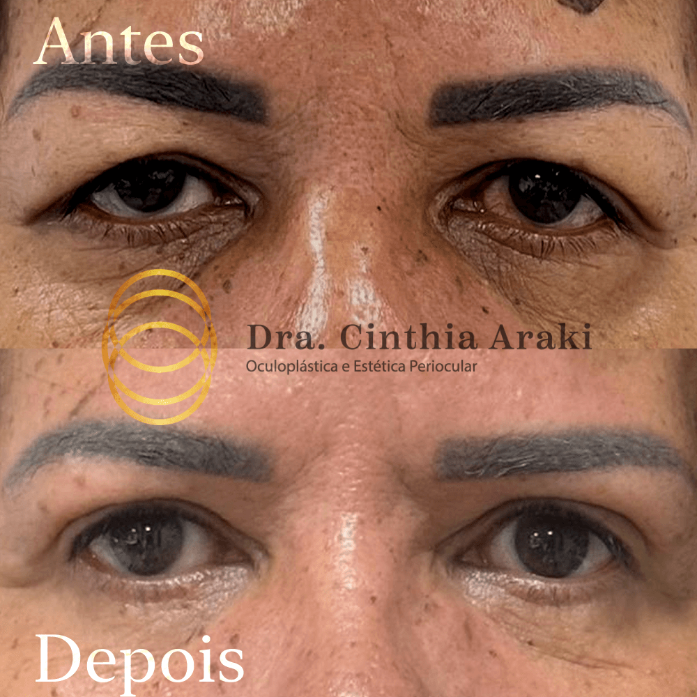 Antes e depois 11