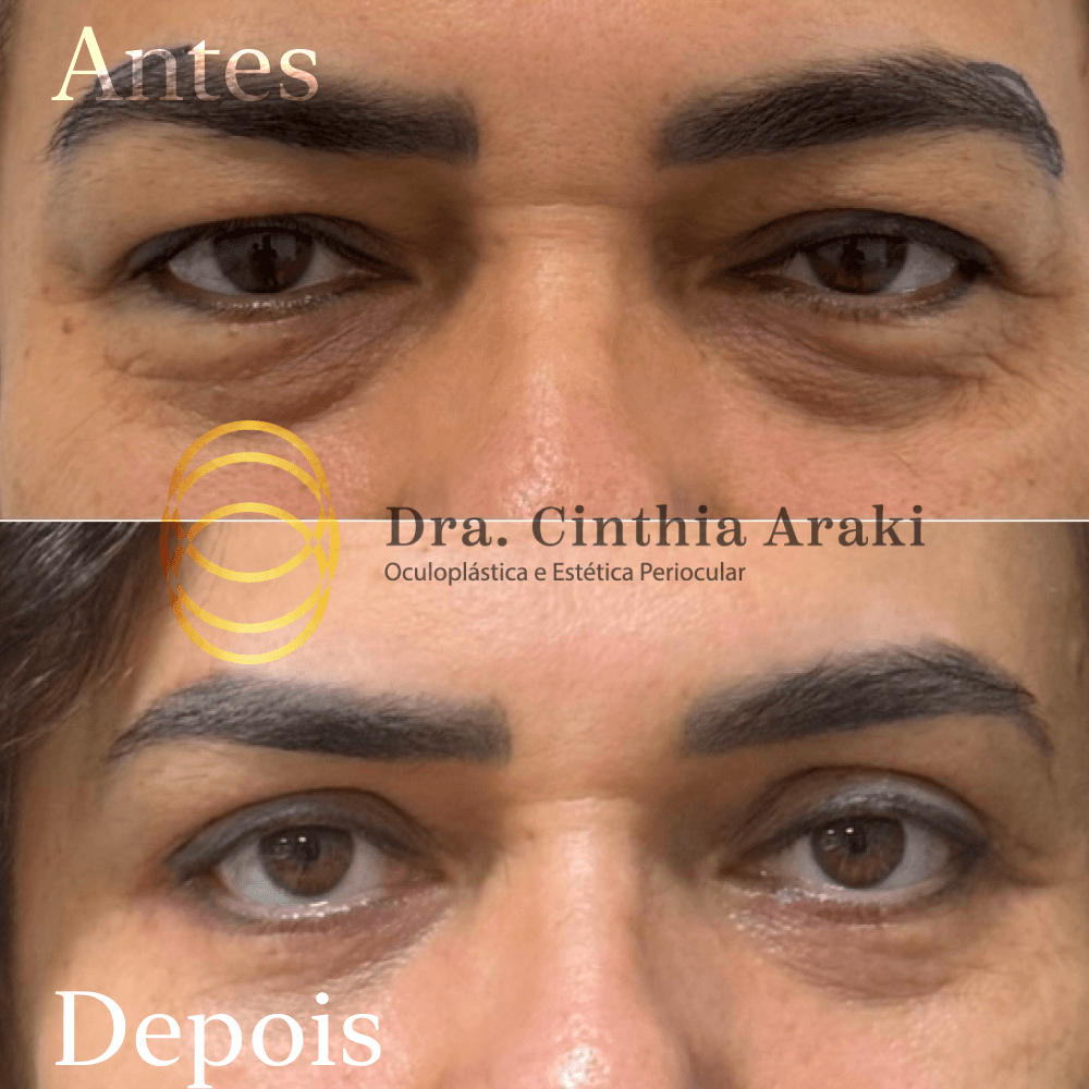Antes e depois 14
